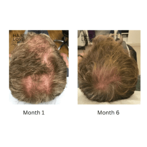Male Pattern Hair Loss Androgenic Alopecia 