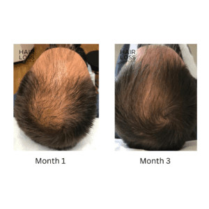 Male Pattern Hair loss Androgenic alopecia 