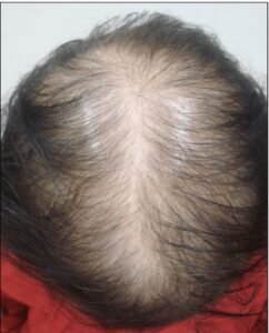 Female Pattern hair loss, hair loss in women