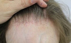 Frontal Fibrosing Alopecia 