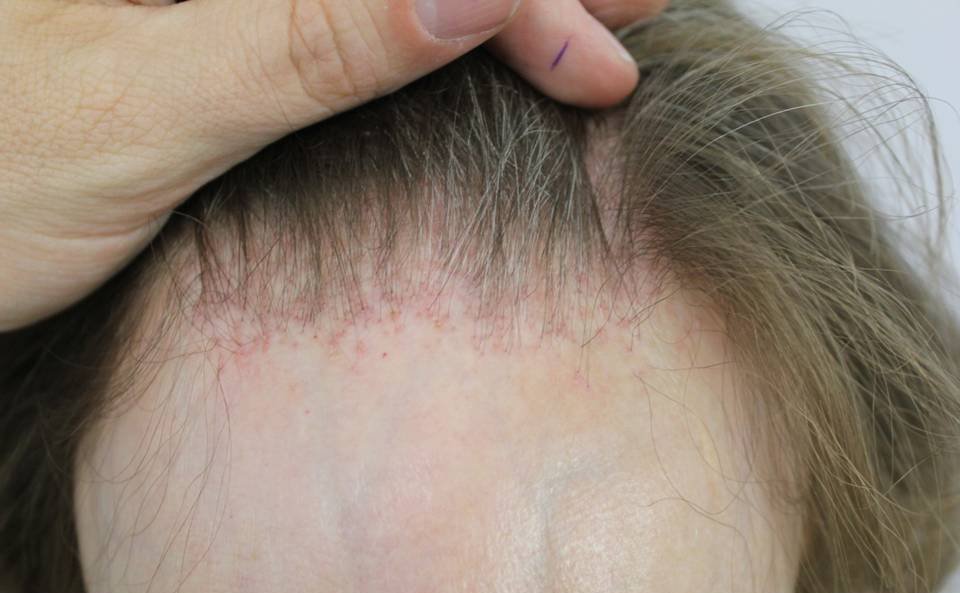 Frontal Fibrosing Alopecia