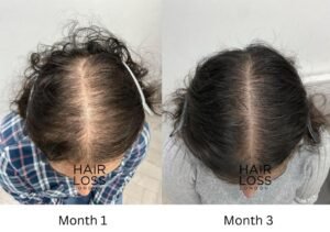 Female pattern hair loss