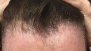 Frontal Fibrosing Alopecia