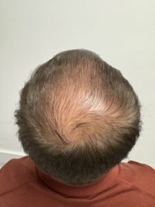 male pattern hair loss, androgenic alopecia, hair loss in men