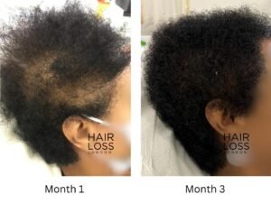 Traction Alopecia
