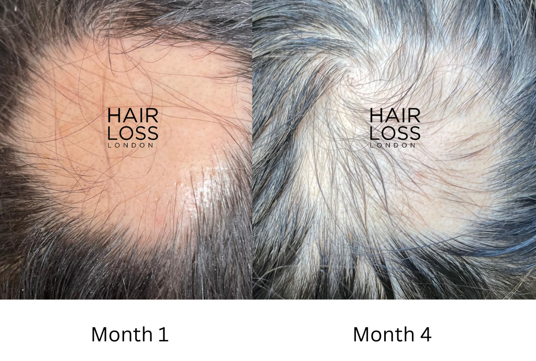 Alopecia Areata