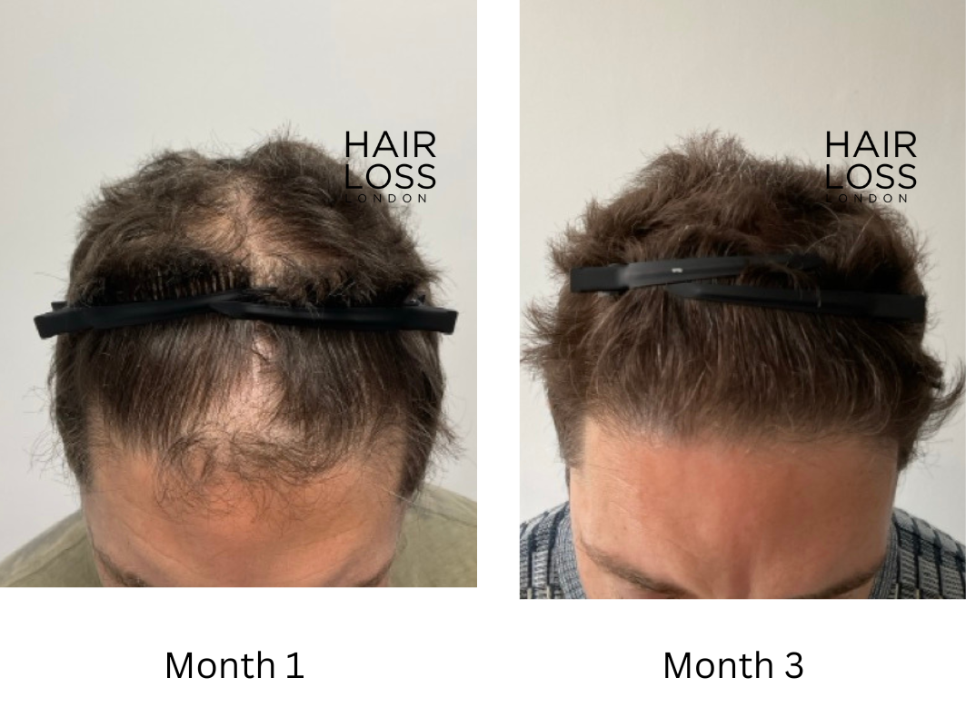 Plasma rich hair treatment