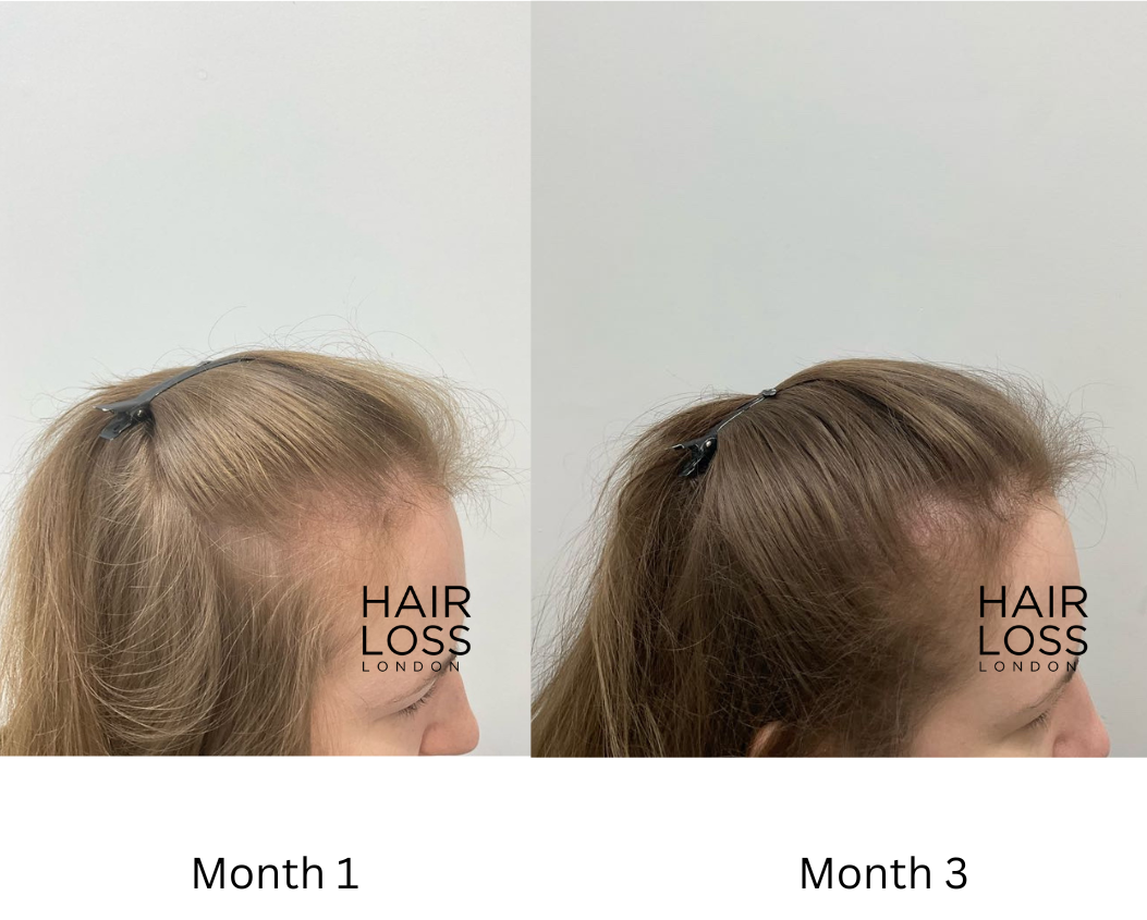 Platelets rich plasma hair treatment