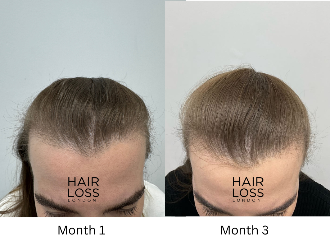 Women's receding hairline