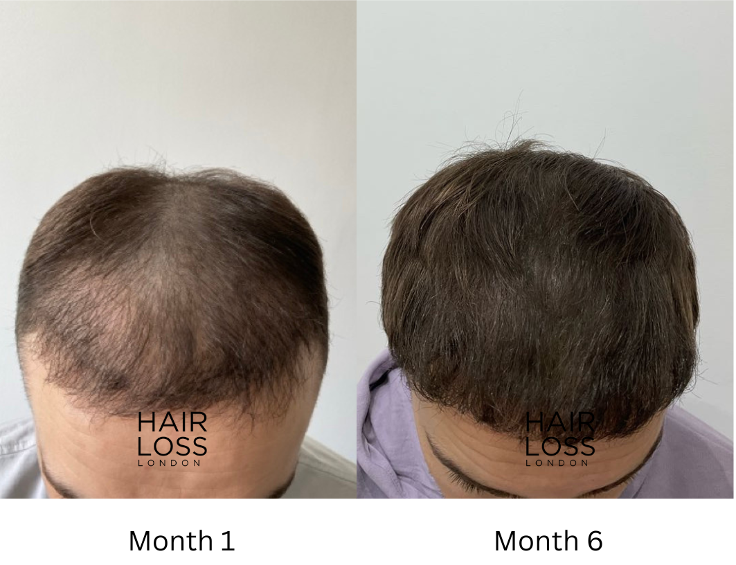 Regrow men's hair