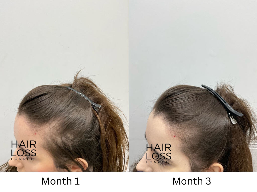 PRF treatment for hair loss