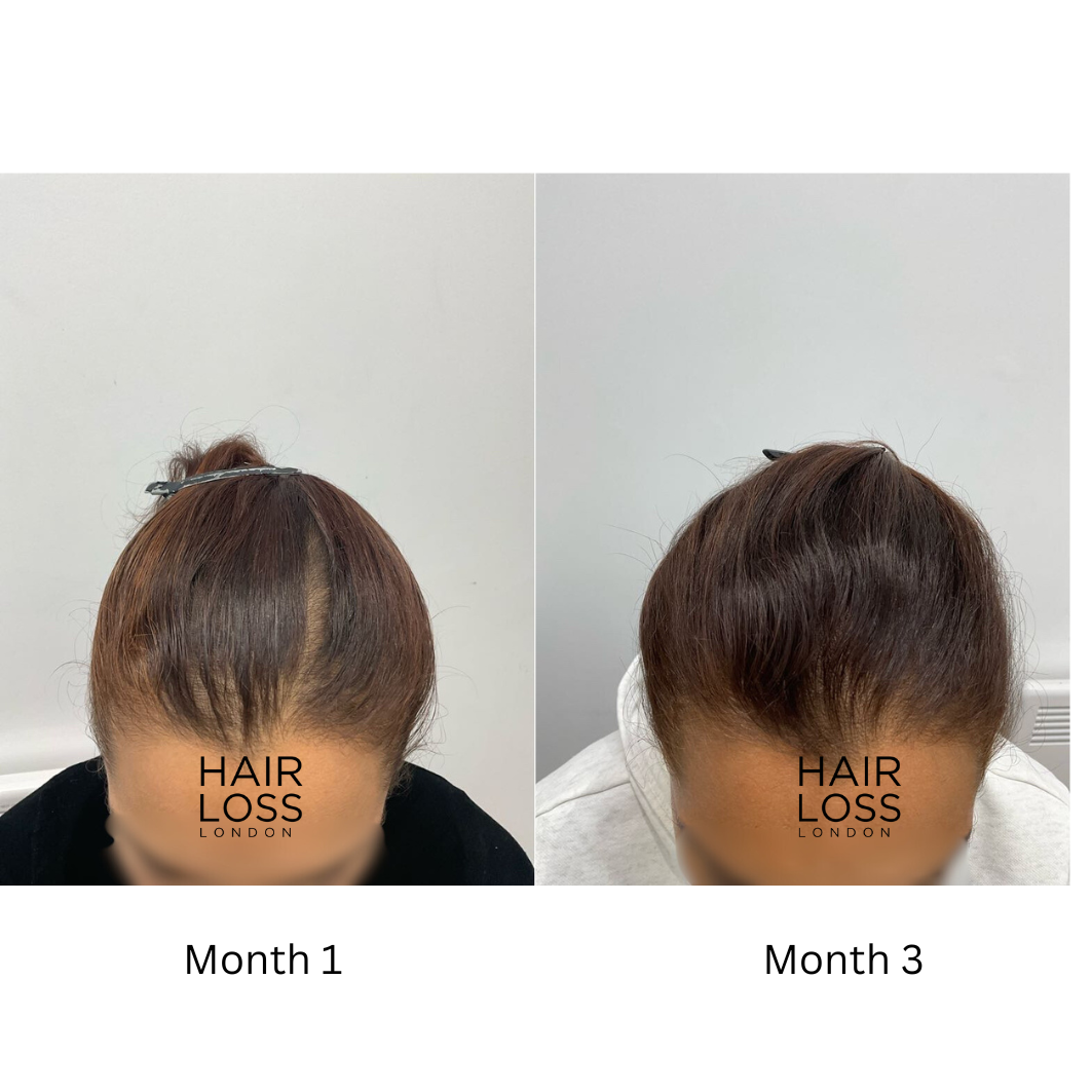 low dose oral minoxidil women