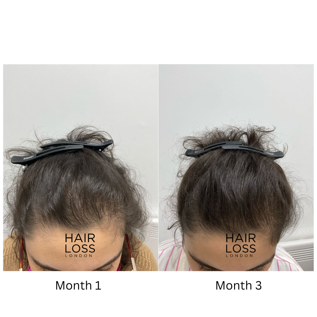 minoxidil female pattern hair loss