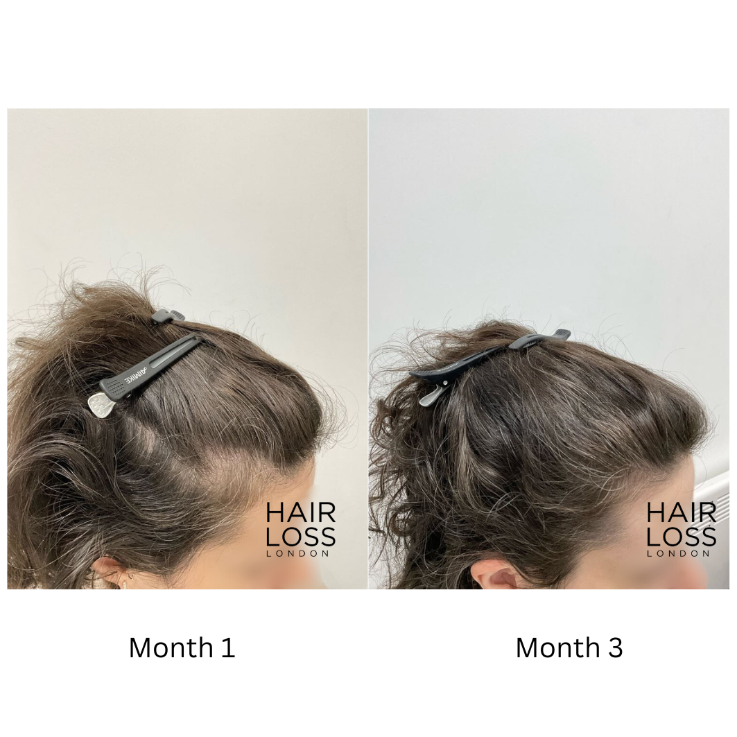 iron deficiency hair loss