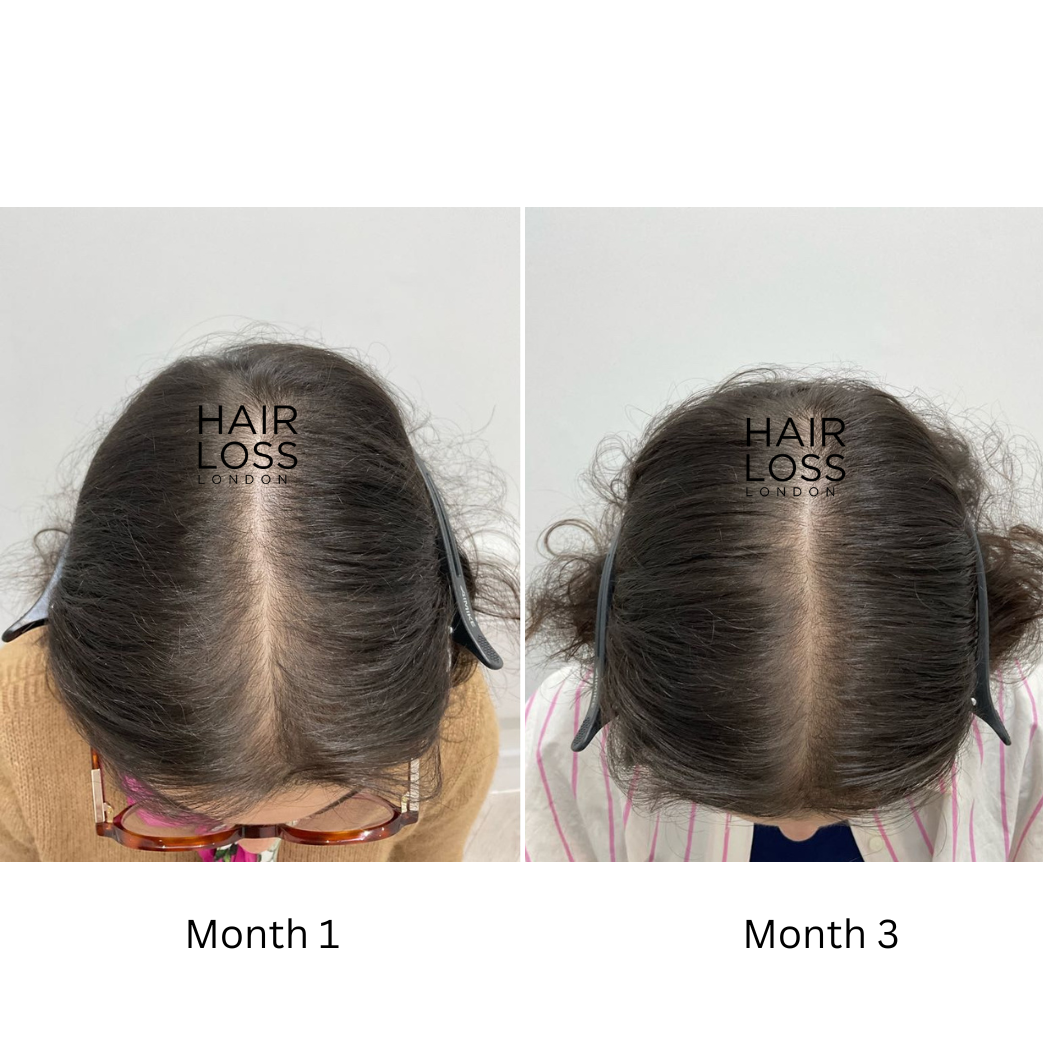 finasteride female hair loss