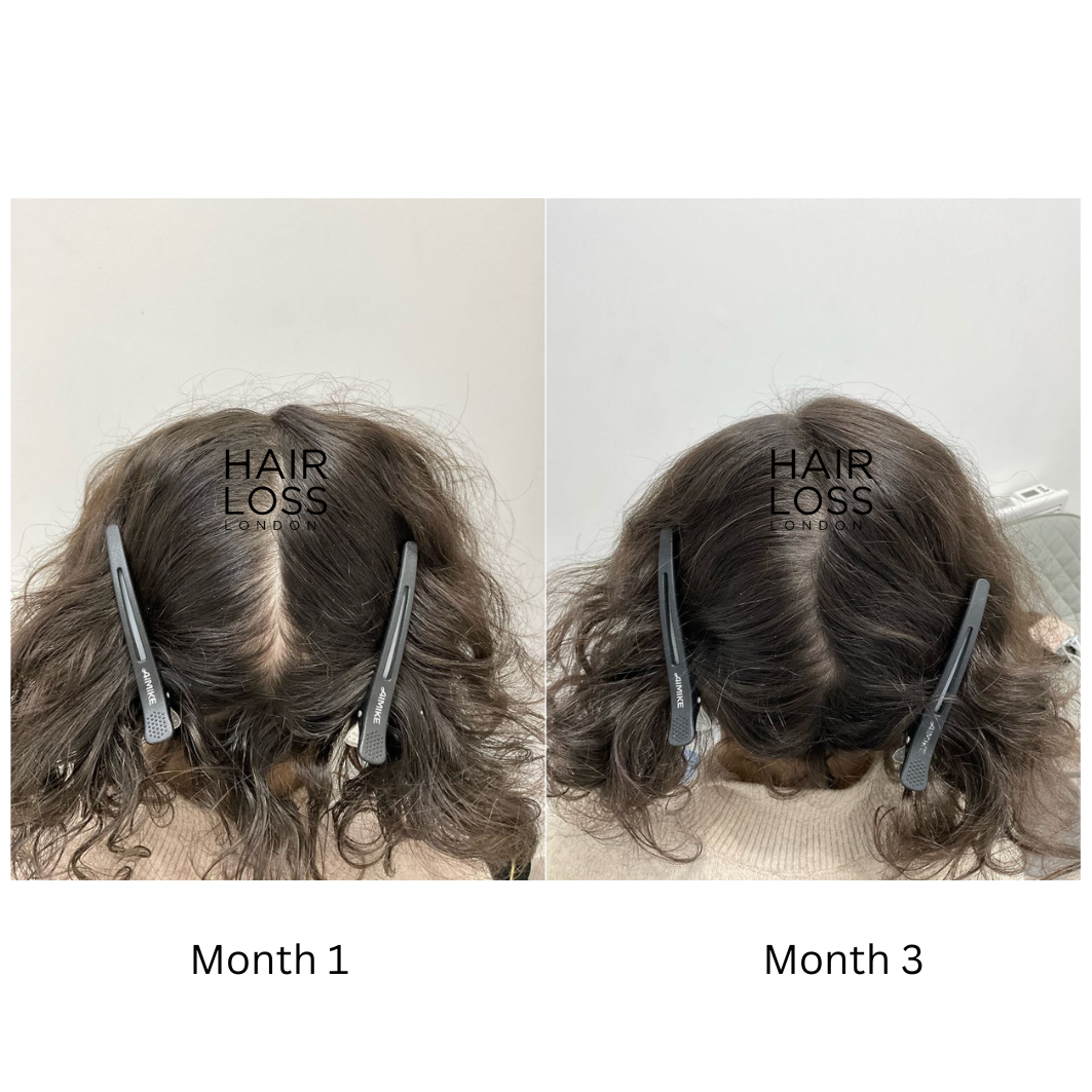 stress-related hair shedding
