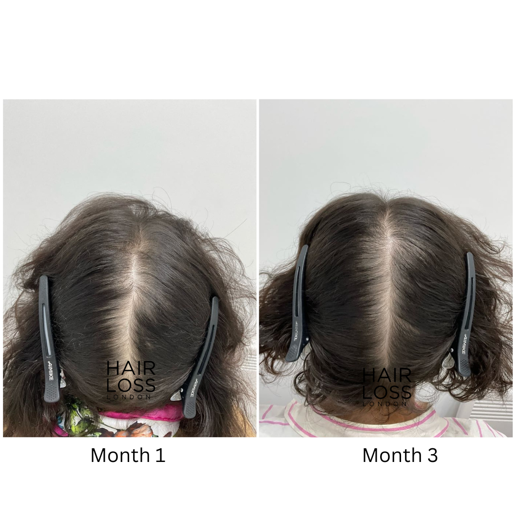 dutasteride women androgenetic alopecia