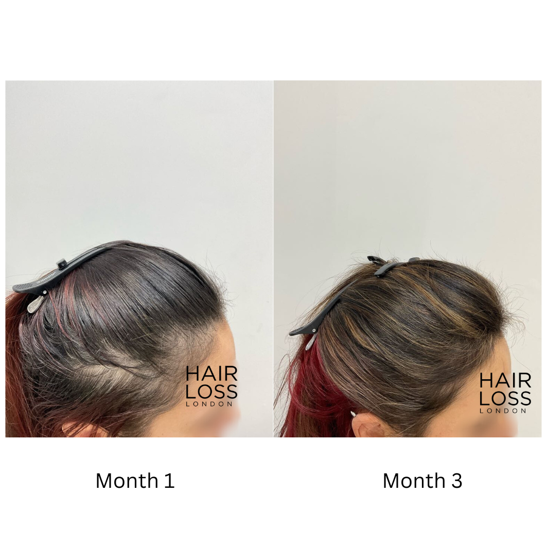 topical vs oral minoxidil women results