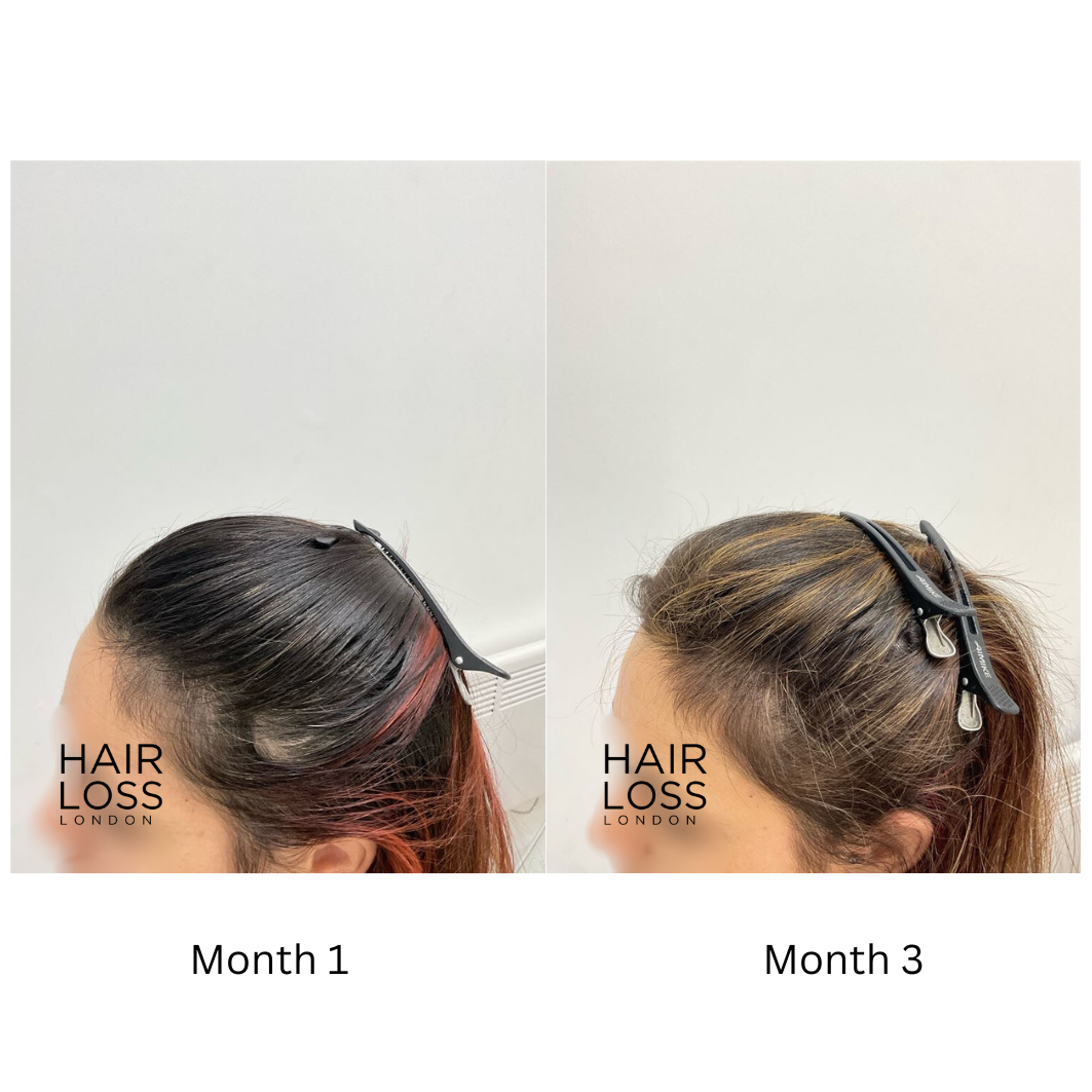 platelet rich plasma PRP female pattern hair loss
