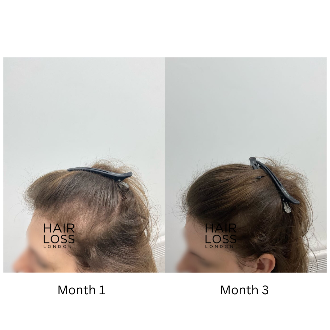 dutasteride women androgenetic alopecia