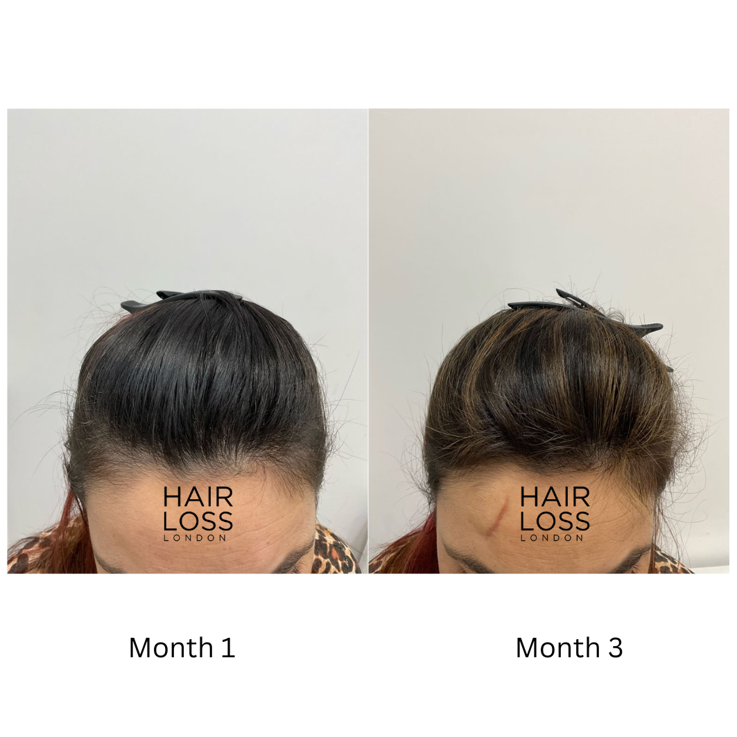 PRP therapy for female hair loss reviews