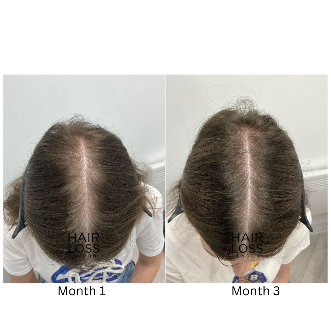 androgenetic alopecia diagnosis female