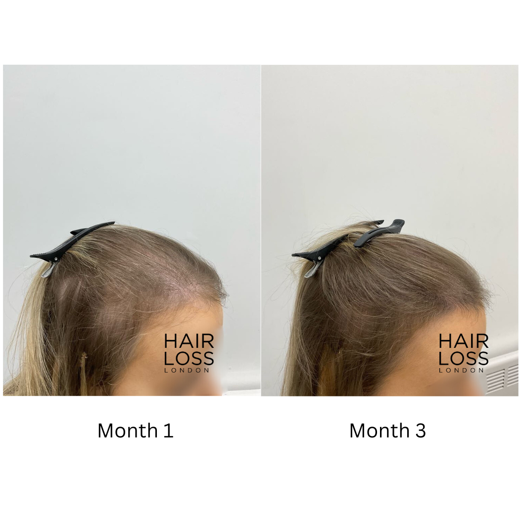 spironolactone for women’s hair loss side effects