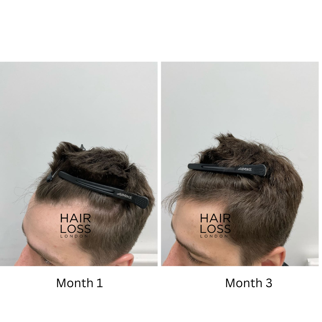 oral minoxidil low dose male