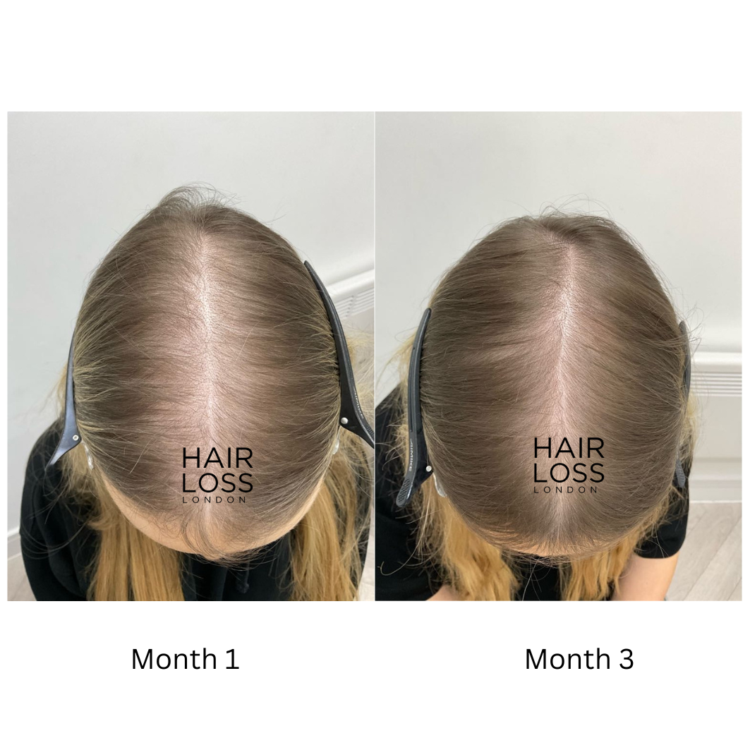 dutasteride safety women hair growth