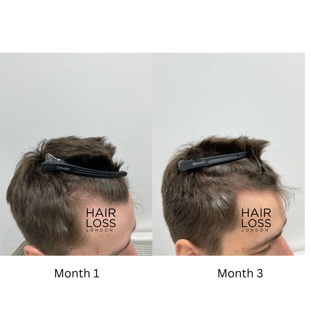 male hair thinning causes