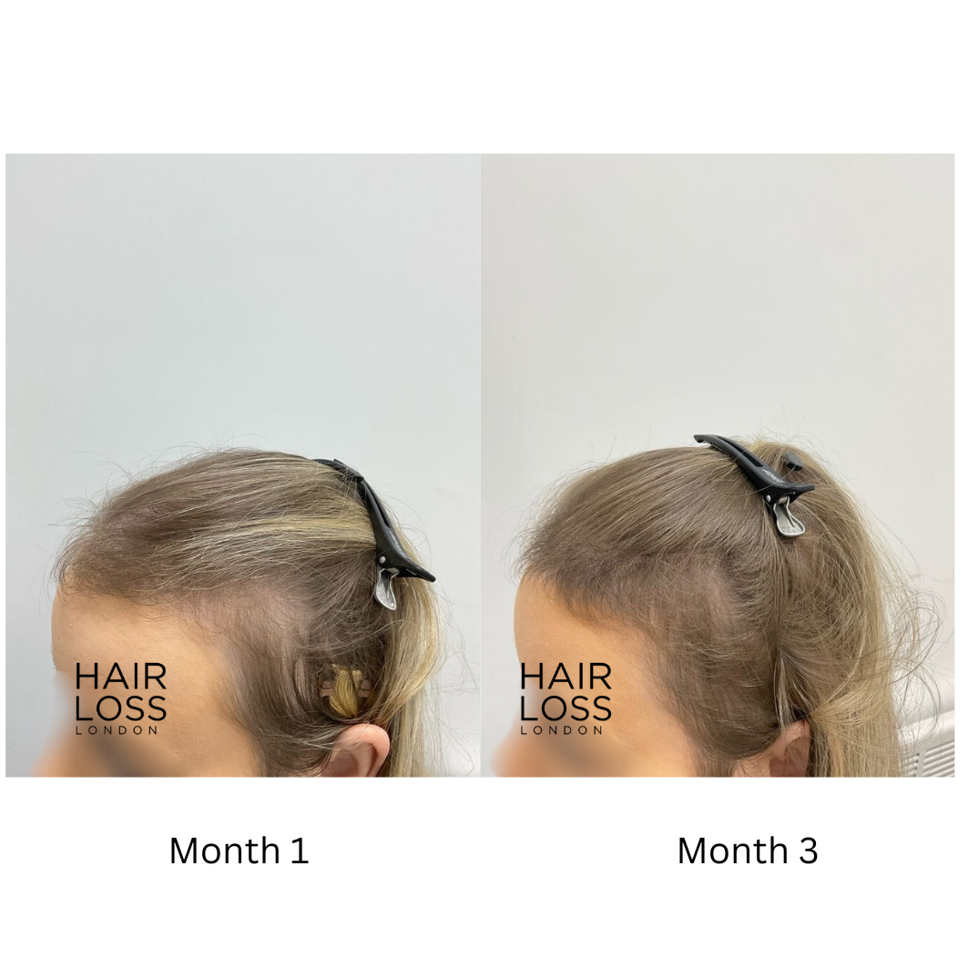 spironolactone for female hair loss