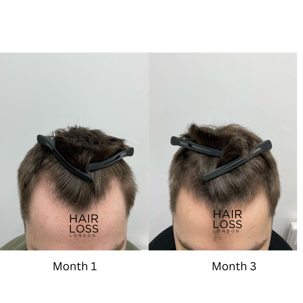 best treatments for male pattern baldness 2025