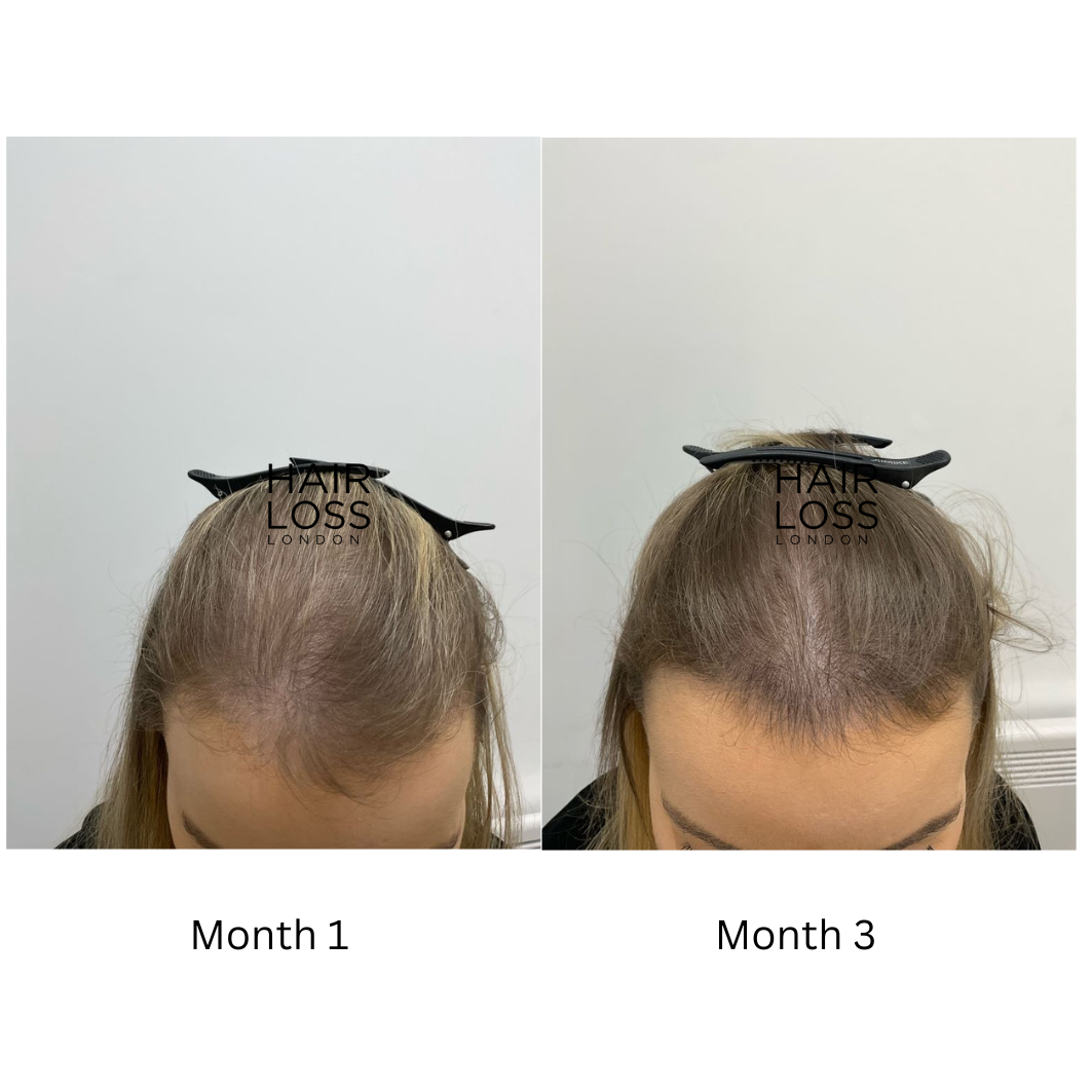 thinning hair women