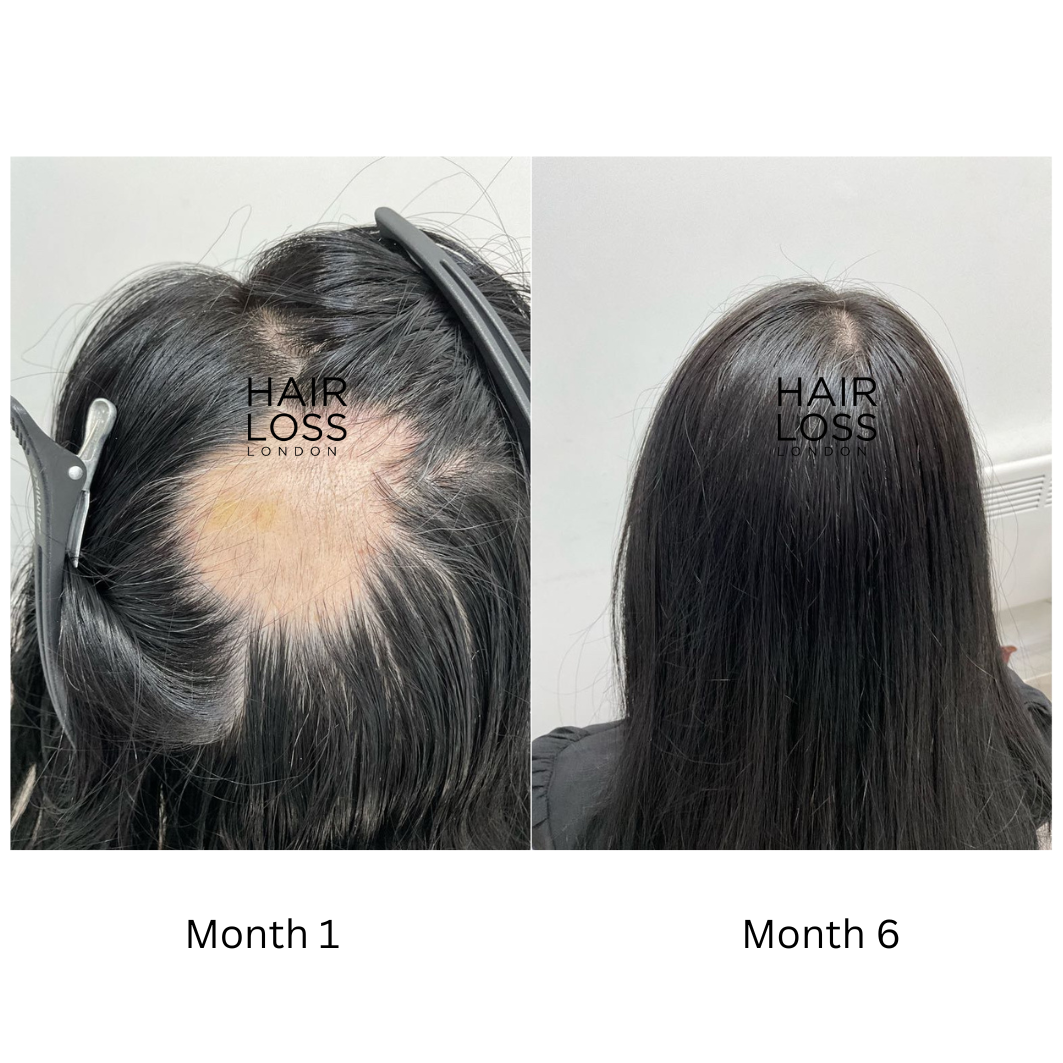Alopecia Areata