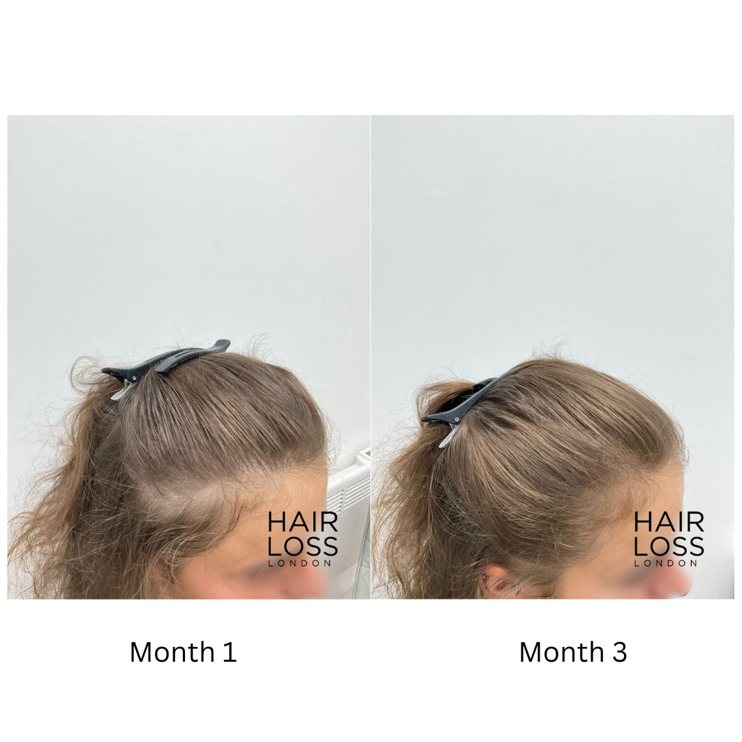 early signs female pattern hair loss