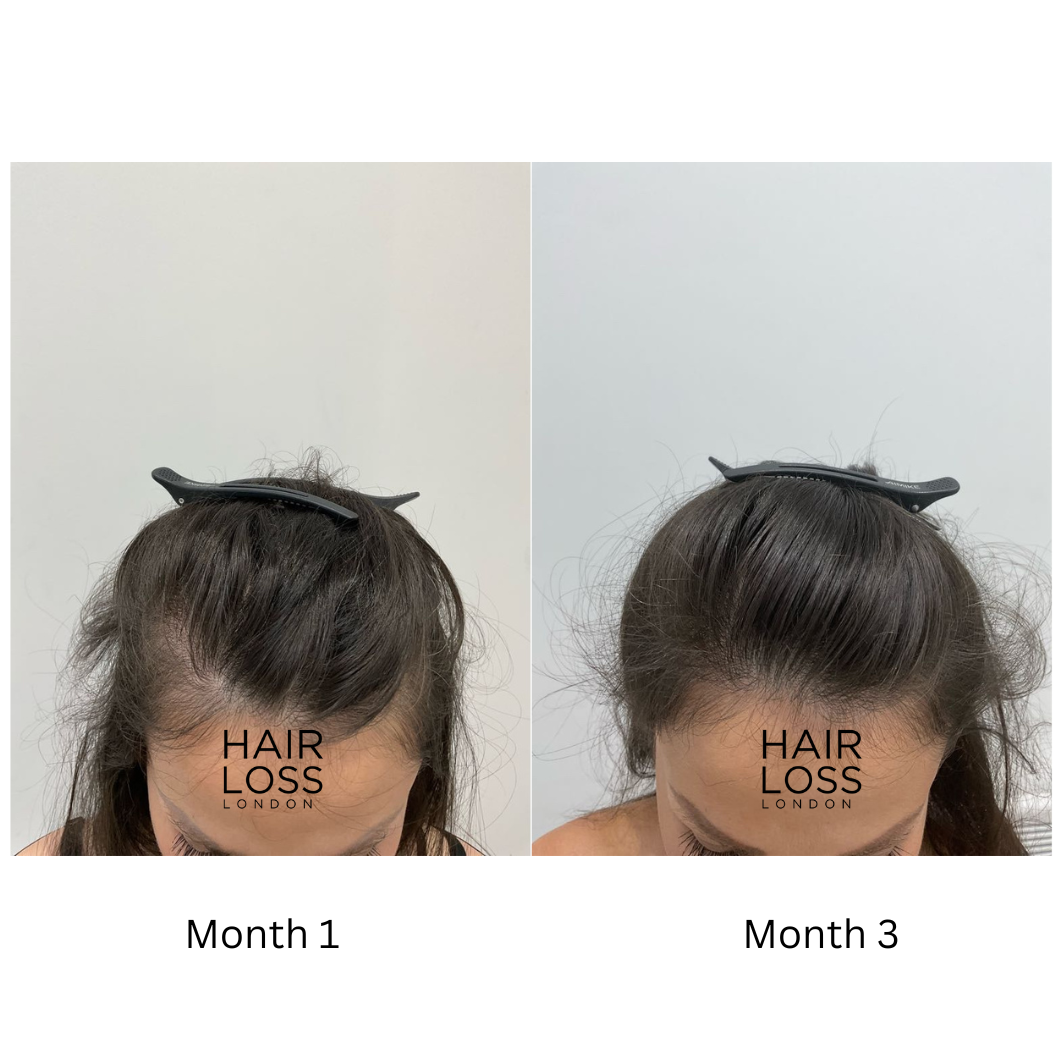 telogen effluvium women