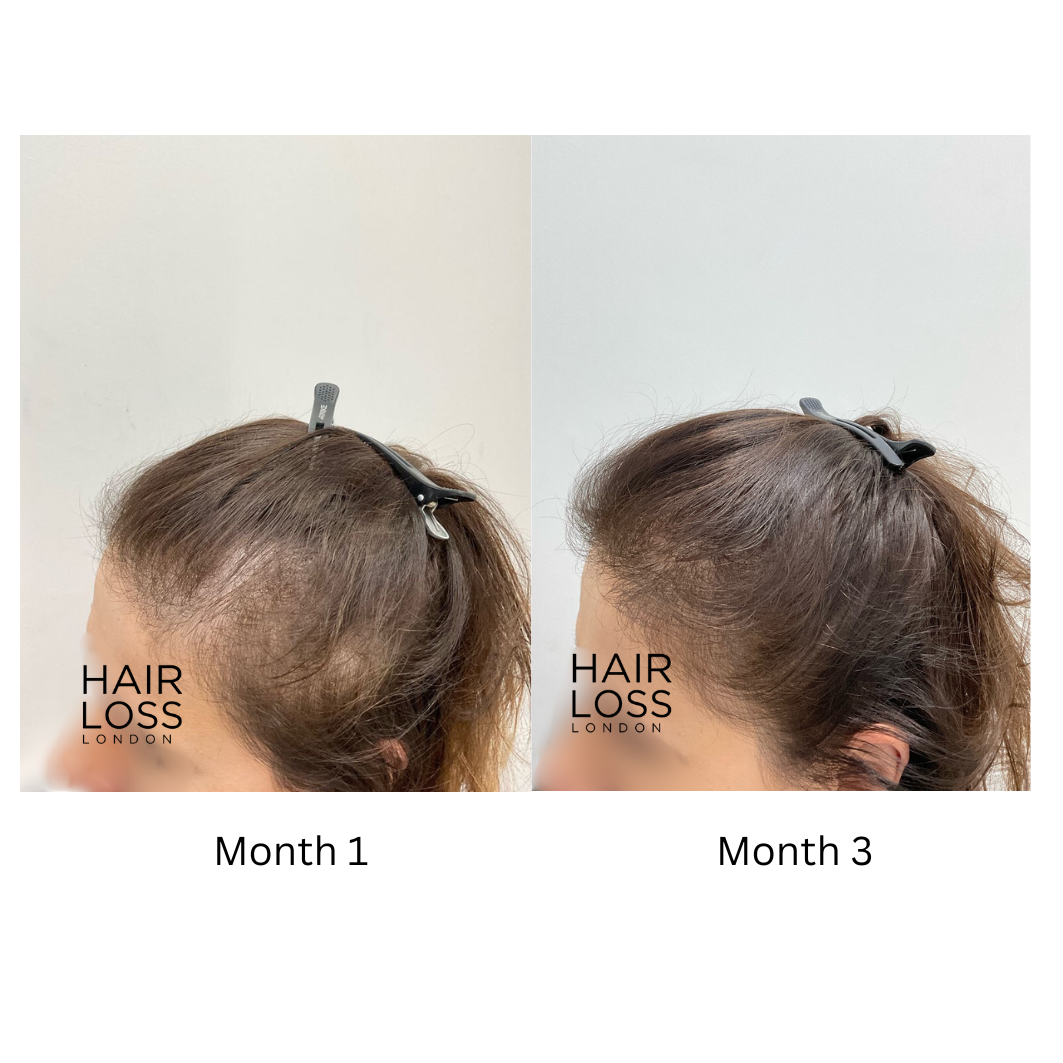 PCOS hair loss