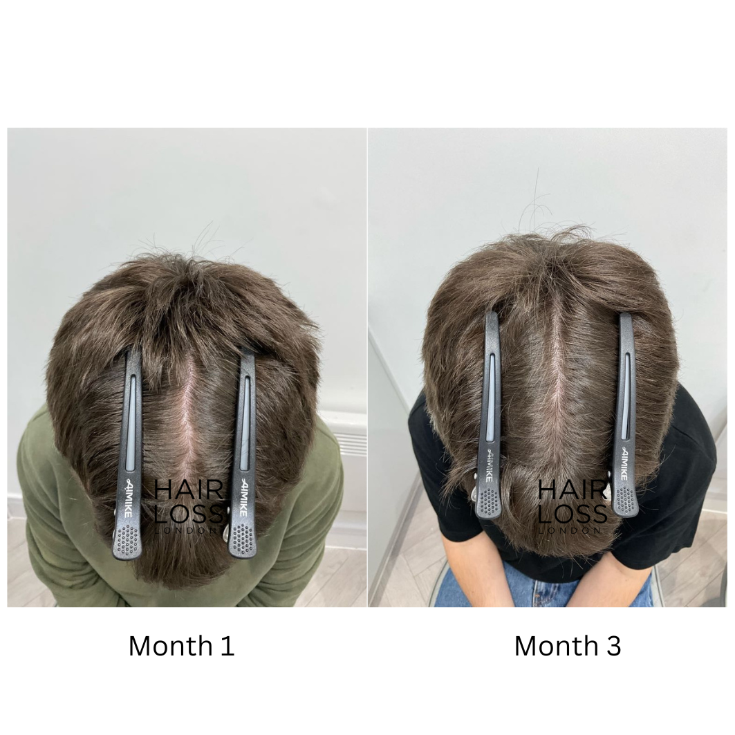 finasteride for male hair loss safety