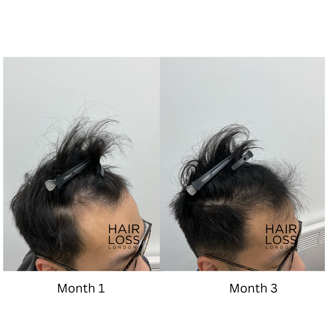 male pattern baldness
