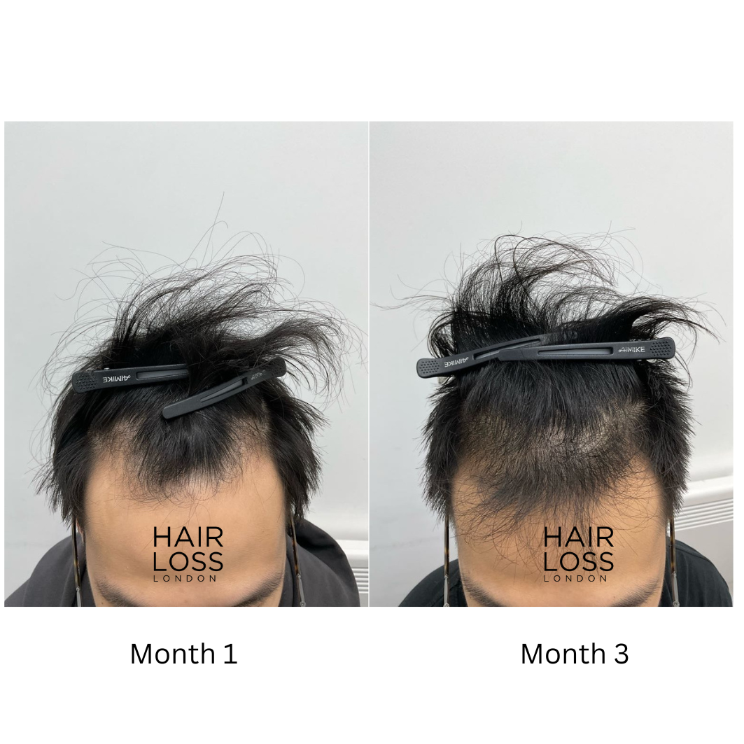 male hair loss