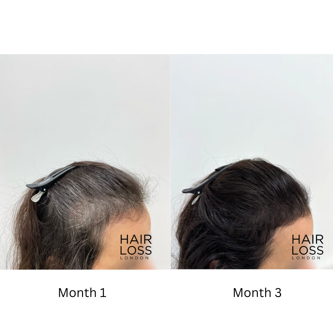 iron deficiency hair loss