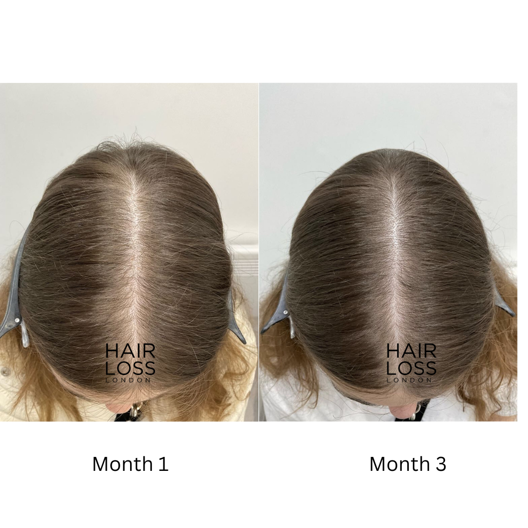 hair care tips for thinning hair female