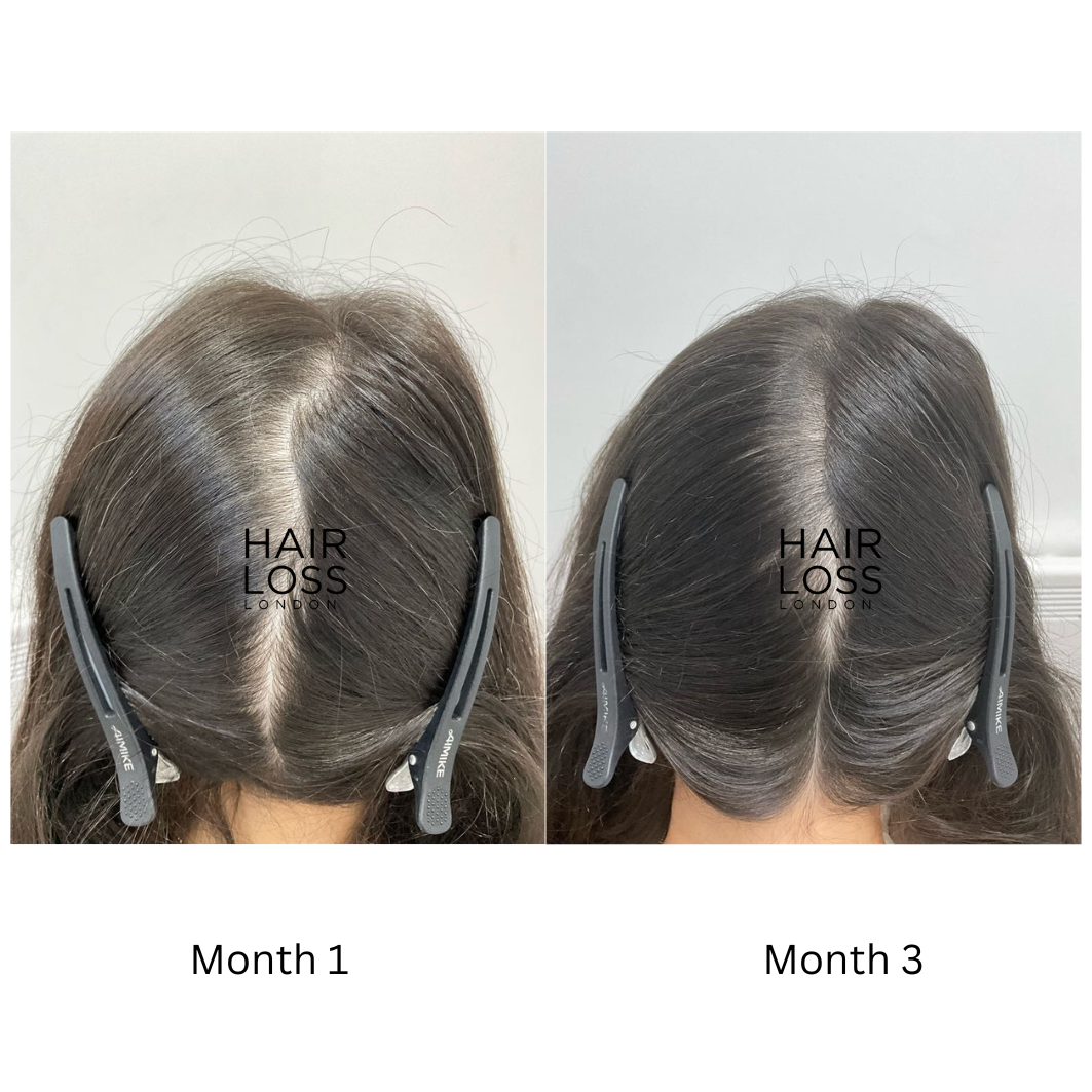 female telogen effluvium hair shedding