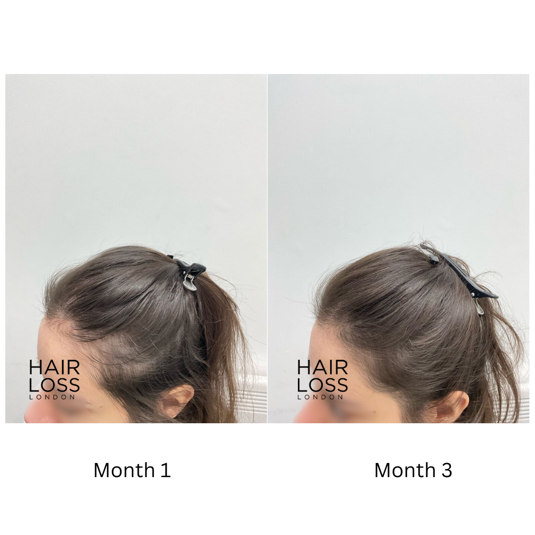 diffuse thinning women