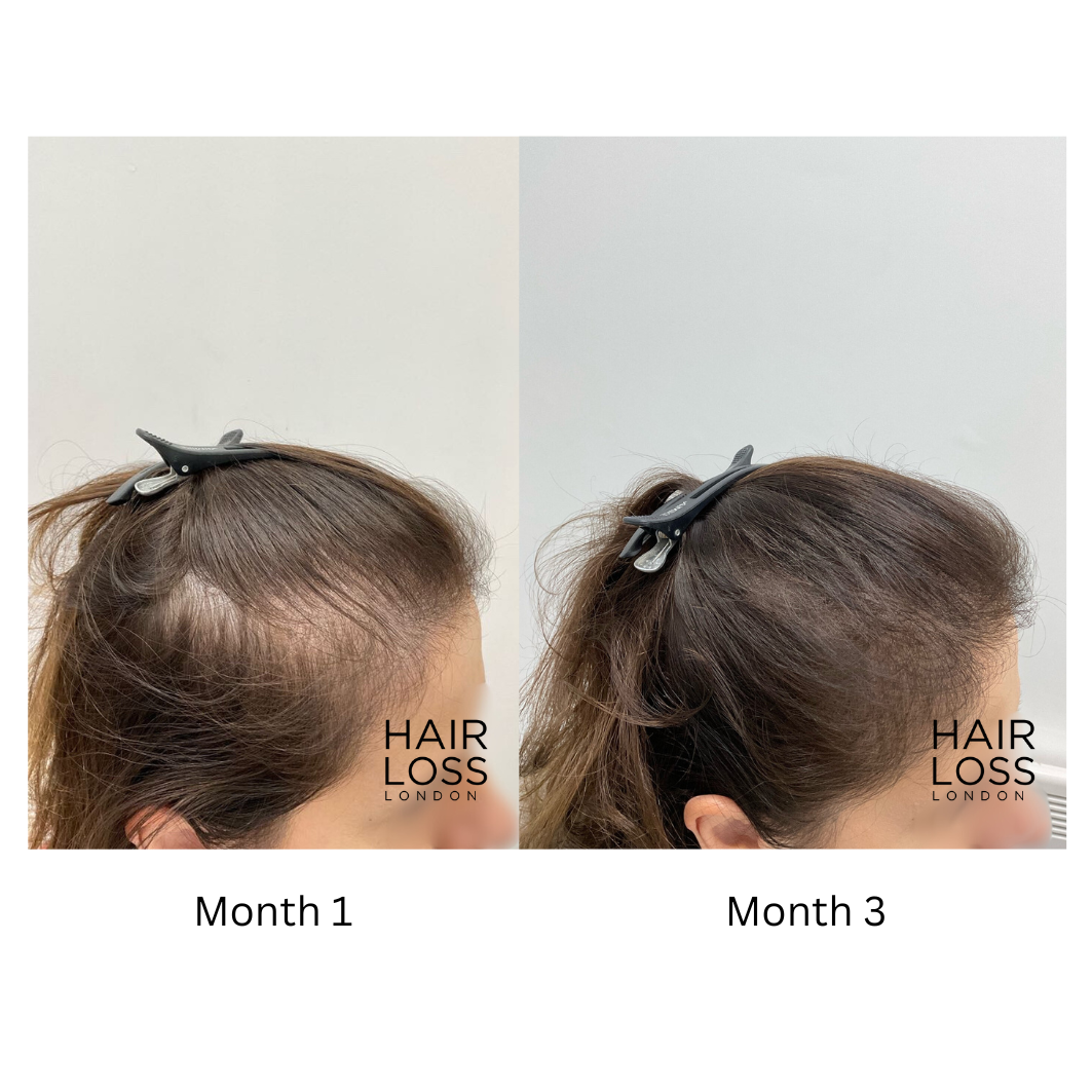 androgenic alopecia PCOS women