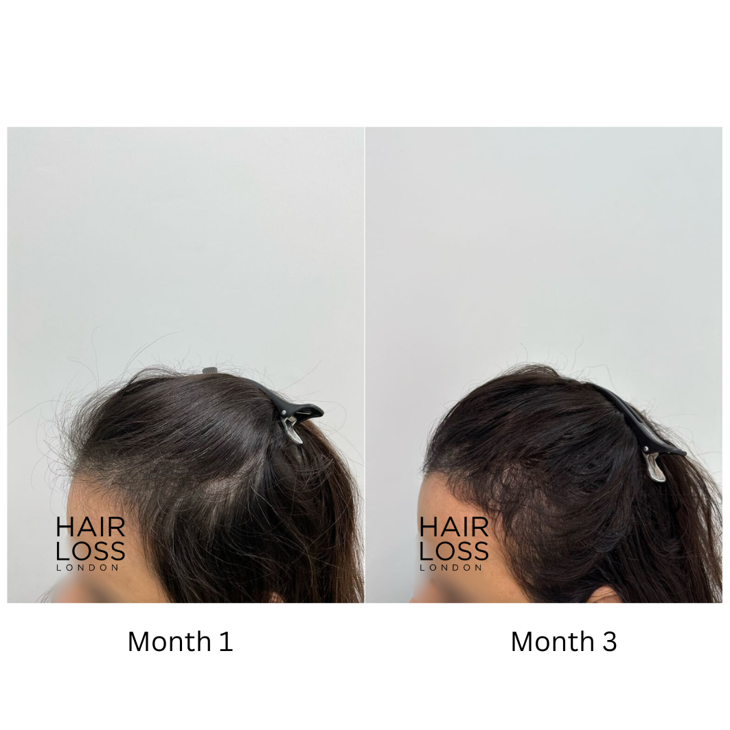 low-level laser therapy hair