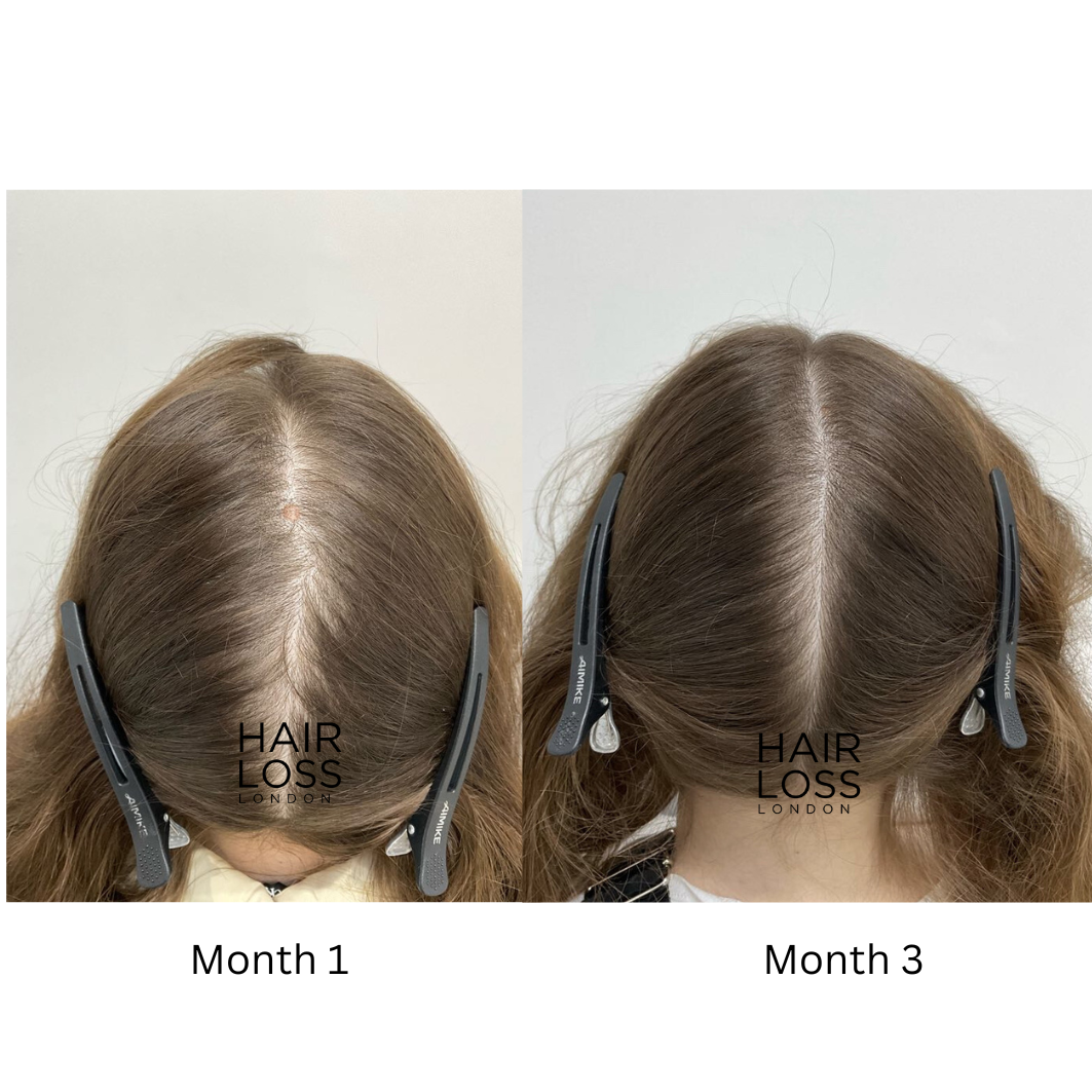 female hair loss support groups forums