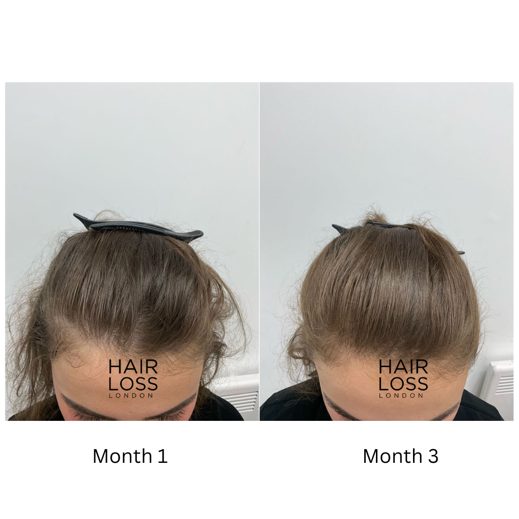 diffuse thinning