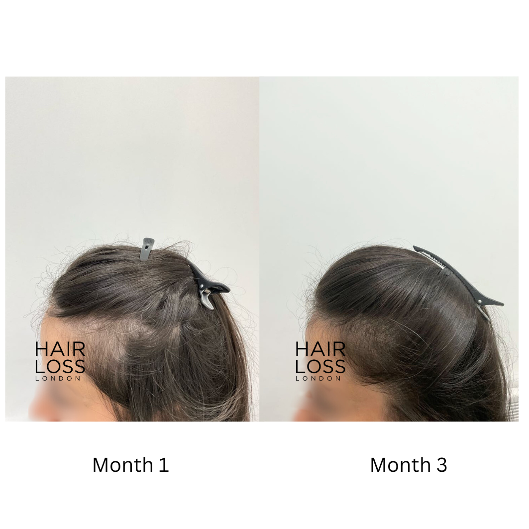 diffuse hair shedding female