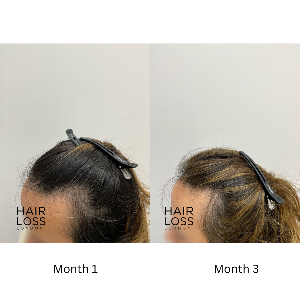 nutritional supplements for hair loss